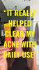 IT HELPED CLEAR MY ACNE
